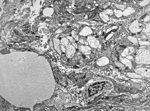 Whipple disease Whipple disease